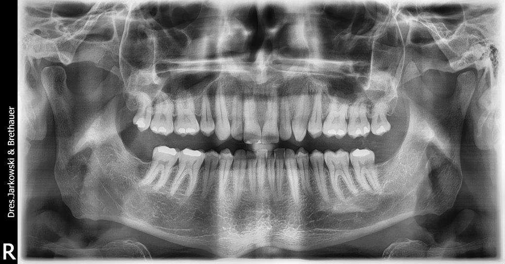 Das Bild zeigt eine Rötgenaufnahme von Zähnen